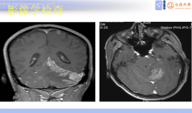 脑膜转移诊疗潘振宇教授科普总结